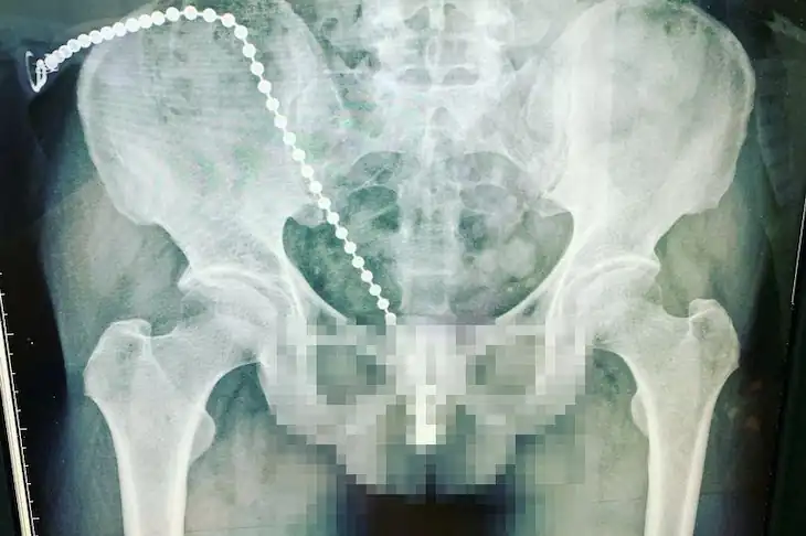 Xray, Zakar, Rantai Di Dalam Zakar