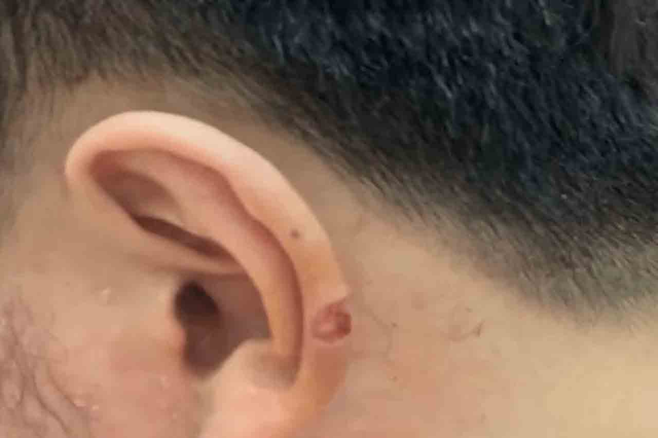 Terpotong Telinga Semasa Gunting Rambut, Lelaki Hanya Dibayar RM127 Ganti Rugi